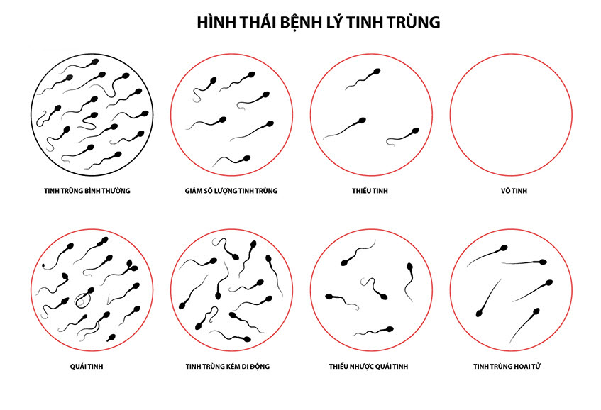 Không có tinh trùng: Thủ phạm hàng đầu gây vô sinh ở nam giới